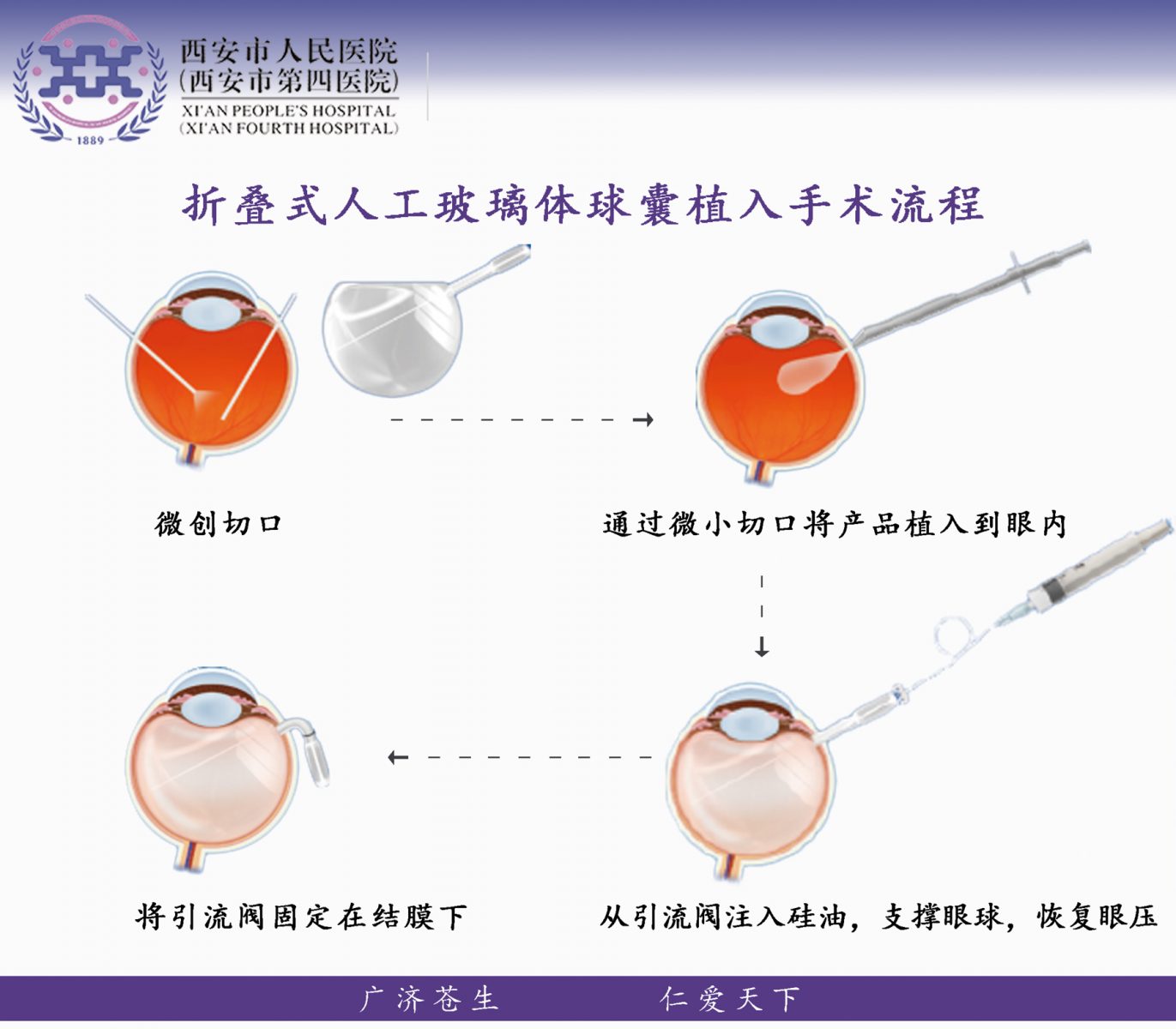 折叠式人工玻璃体球囊 | 广州卫视博生物科技有限公司 - 官网